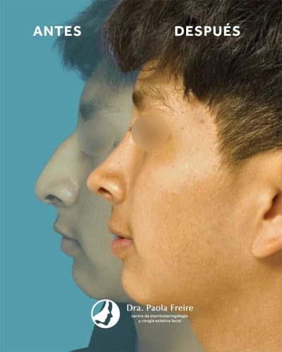 Dra Paola Freire Rinoplastia Quito 23-min