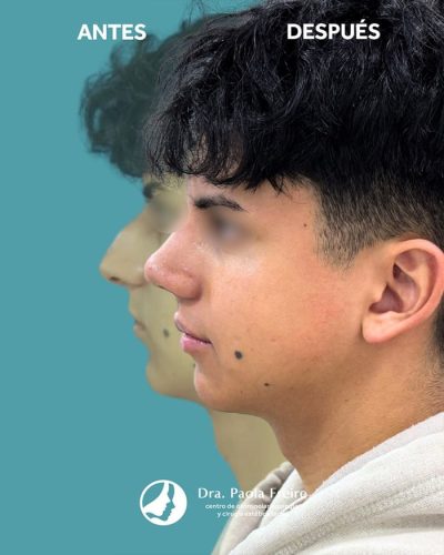 Dra Paola Freire Rinoplastia Quito 24-min