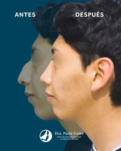 Dra Paola Freire Rinoplastia Quito 25-min