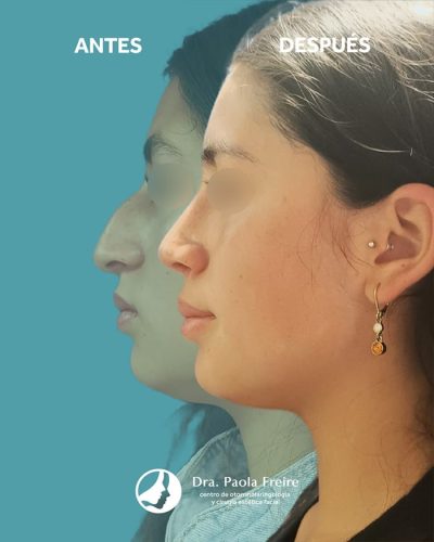 Dra Paola Freire Rinoplastia Quito 27-min