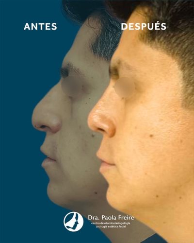 Dra Paola Freire Rinoplastia Quito 28-min