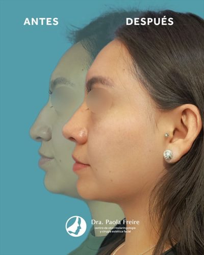 Dra Paola Freire Rinoplastia Quito 29-min