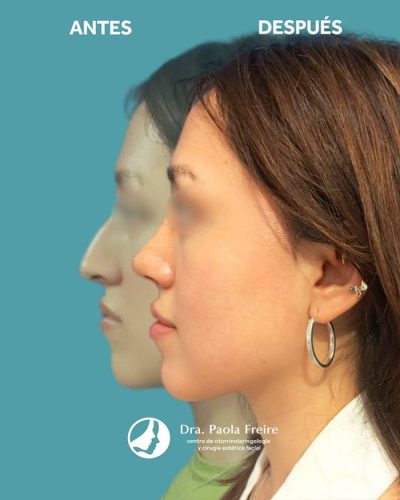 Dra Paola Freire Rinoplastia Quito 30-min